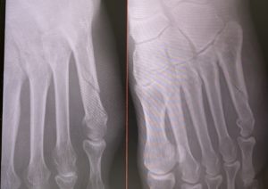 第五中足骨骨折