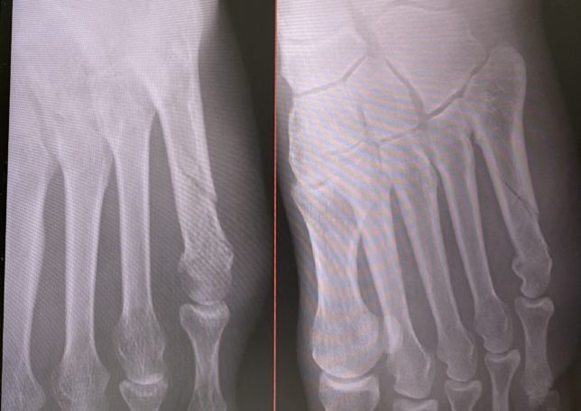 第五中足骨骨折