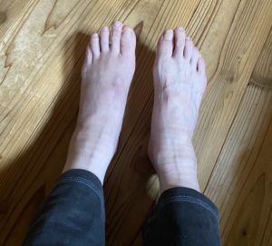 左足の骨折2ヶ月目