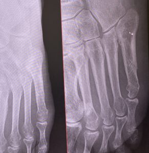 第5中足骨骨折3ヶ月